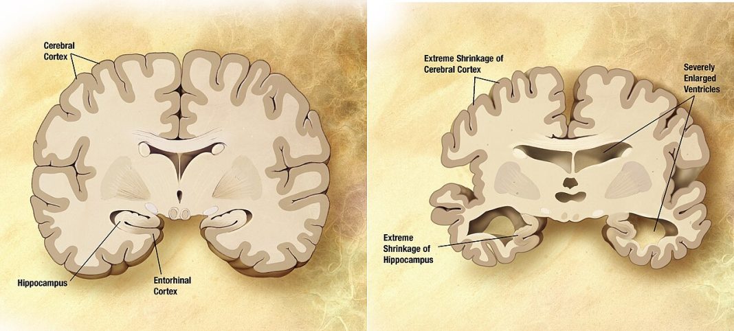Comparaison d’un cerveau normal et d’un cerveau atteint de la maladie d’Alzheimer