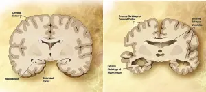 Comparaison d’un cerveau normal et d’un cerveau atteint de la maladie d’Alzheimer