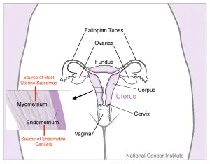 Schéma anatomique de l’utérus et des tissus où peuvent apparaître des cancers