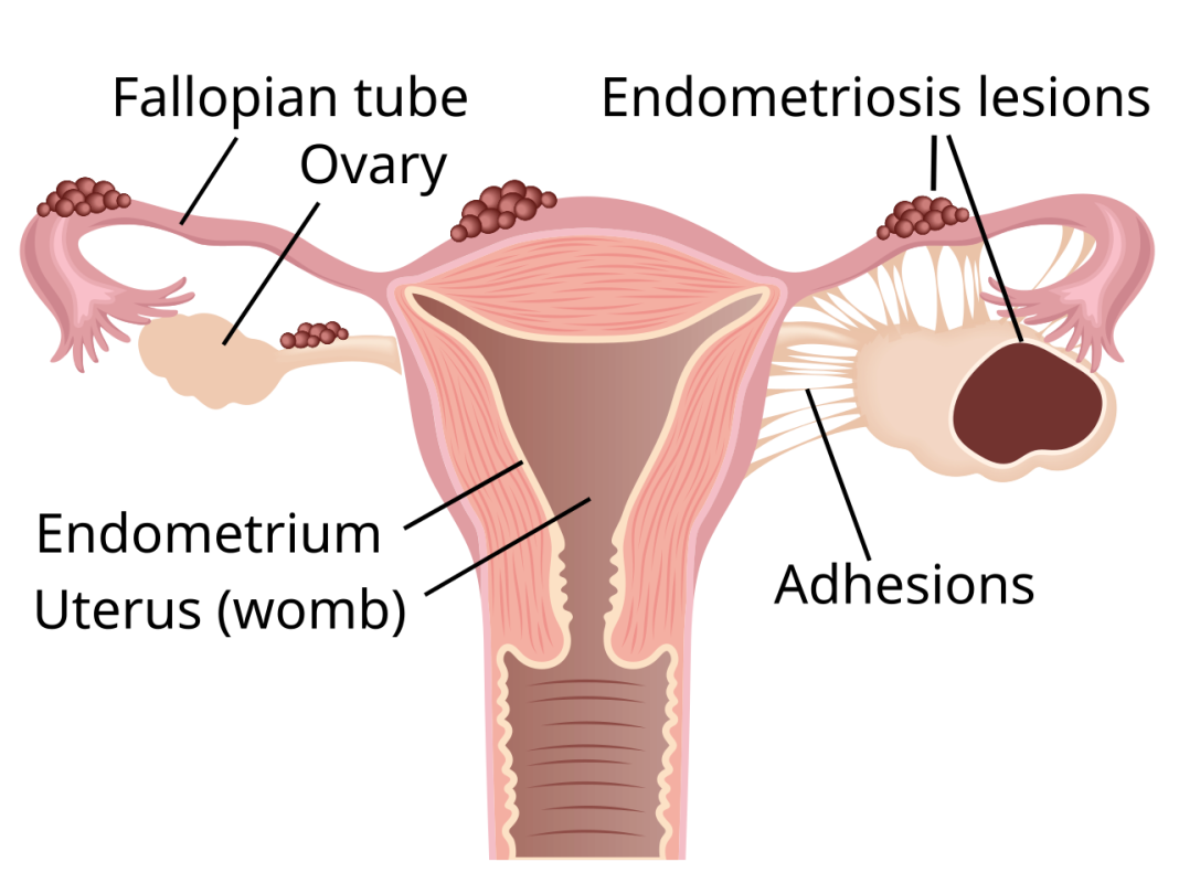 Schéma anatomique de l’endométriose avec lésions et endométriome ovarien