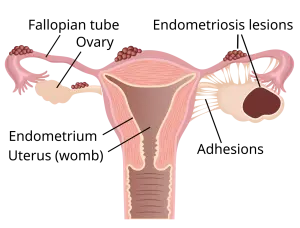 Schéma anatomique de l’endométriose avec lésions et endométriome ovarien