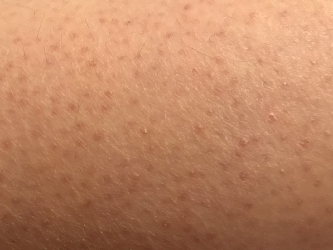 Kératose pilaire modérée avec petites bosses rugueuses sur la peau