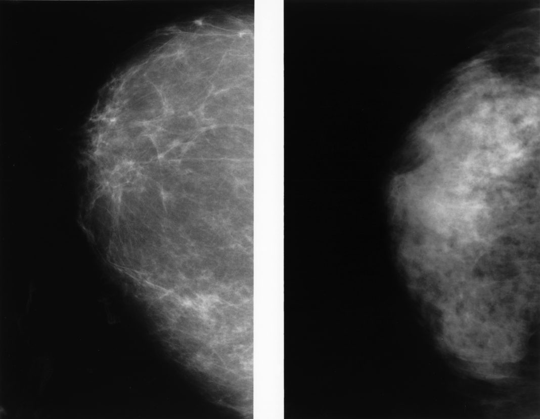 Mammographies comparant un sein dense et un sein graisseux