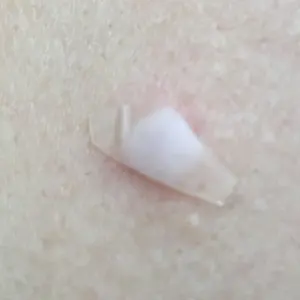 Pansement hydrocolloïde utilisé comme illustration des patchs anti-boutons
