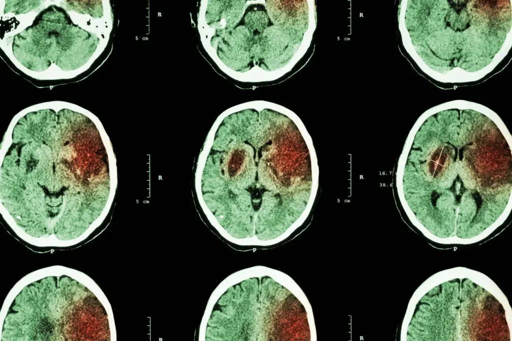 Scanner cérébral utilisé pour le diagnostic des AVC