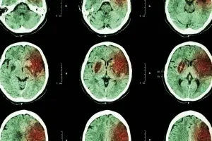 Scanner cérébral utilisé pour le diagnostic des AVC